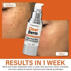 Ceoerty® ClearDerm Advanced Wart Mole & Dark Spot Repair Serum